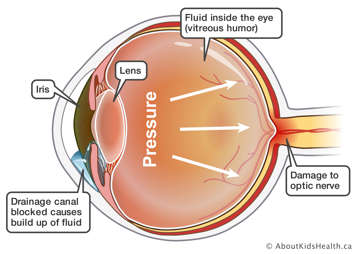 Inside view of the eyeball showing how with glaucoma fluid buildups in the front part of the eye increasing pressure inside the eyeball causing damage to the optic nerve