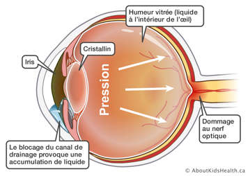 Vue intérieure du globe oculaire atteint de glaucome où l’accumulation de liquide dans la partie avant de l’œil augmente la pression sur le globe oculaire, provoquant des dommages au nerf optique