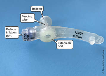Parts of an AMT MiniONE low-profile G tube