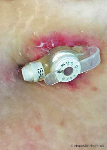 skin breakdown around low-profile feeding tube