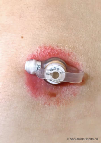 skin irritation around low-profile feeding tube