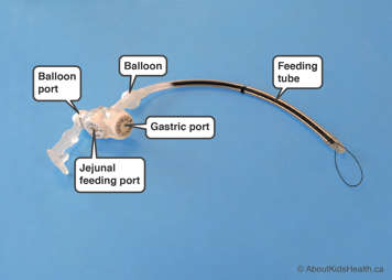 Low-profile combination tube with gastric port, jejunal port and balloon port