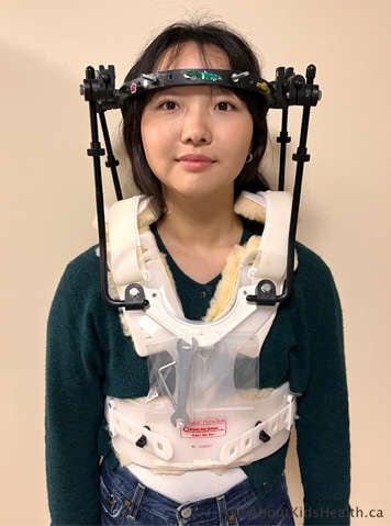 Young woman wearing a halo vest device