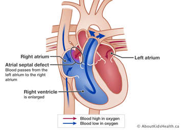 Heart with atrial septal defect that lets blood pass from left atrium to right atrium and enlarge the right ventricle