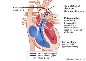 Heart with atrial septal defect that lets blood pass from left atrium to right atrium and enlarge the right ventricle