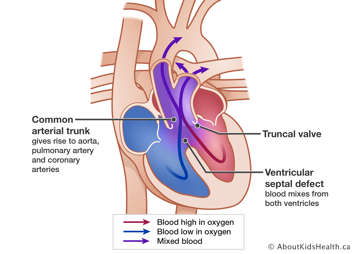 Heart with a common arterial trunk which gives rise to aorta, pulmonary artery and coronary arteries. Ventricular septal defect under trunk allows blood from both ventricles to mix
