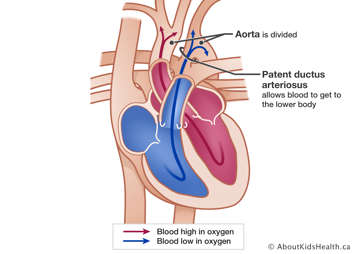 Heart with divided aorta and patent ductus arteriosus that allows blood to get to the lower body