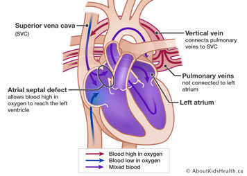 Heart with pulmonary veins attached incorrectly to superior vena cava through a vertical vein. Atrial septal defect allows blood high in oxygen to reach left ventricle.
