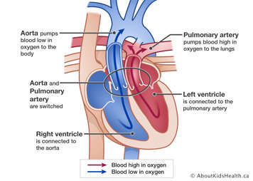 Heart showing aorta and pulmonary artery are switched, aorta pumps blood low in oxygen to body, pulmonary arter pumps blood high in oxygen to lungs, left ventricle connected to pulmonary artery, right ventricle connected to aorta.