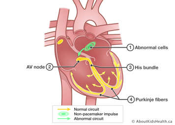 Heart with abnormal cells causing non-pacemaker impulse in left atrium.