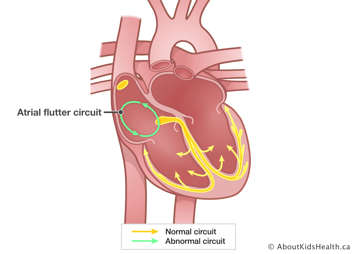 Heart with an abnormal circuit in right atrium.
