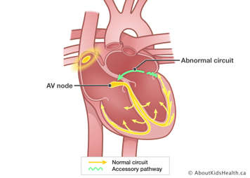 Heart with accessory pathway and abnormal circuit in left atrium leading back to AV node causing fast heart rate.