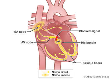 Heart with blocked signal below AV node causing second electrical impulse at His bundle.