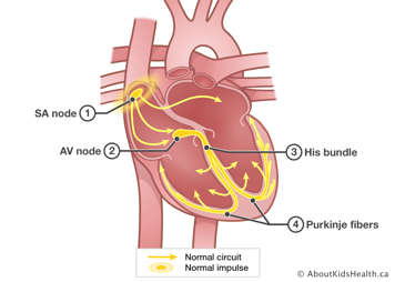 Normal heart showing placement of the SA node, AV node, His bundle and Purkinje fibers