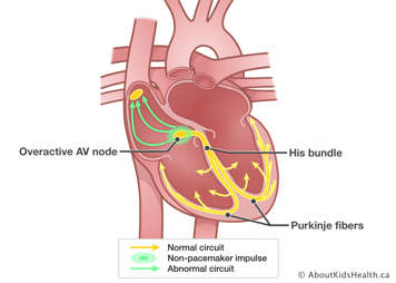 Overactive AV node causes non-pacemaker impulse at AV node, results in abnormal circuit up to SA node.