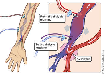 AV fistula and two needles in vein to allow blood to pass to and from the dialysis machine