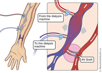 An AV graft attached to a vein and two needles inserted into the vein allowing blood to pass to and from the dialysis machine