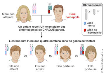 Distribution des chromosomes X et Y d’une mère non atteinte et d’un père hémophile, produisant quatre résultats possibles