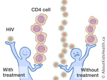 Person with treatment holding one HIV and many CD4 cells, and person without treatment holding few CD4 and many HIV cells