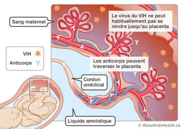Le virus du VIH dans le placenta et les anticorps dans le placenta, le cordon ombilical et le bébé