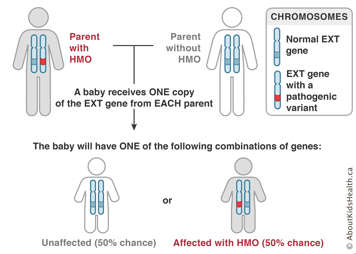 Chromosome distribution from an affected parent with HMO and an unaffected parent shows 50% chance of baby with HMO