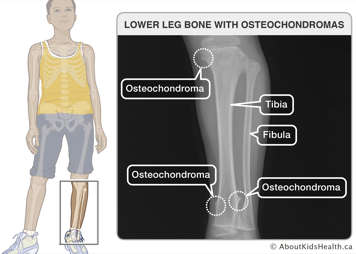 X-ray of lower leg bone with three osteochondromas on the tibia