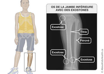 Radiographie de la jambe inférieure avec exostones dans le tibia