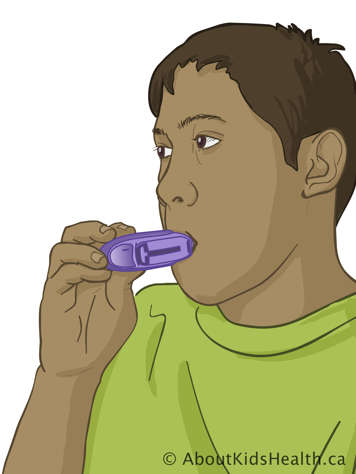 Plaçant l’embout buccal de l’inhalateur Diskus dans la bouche