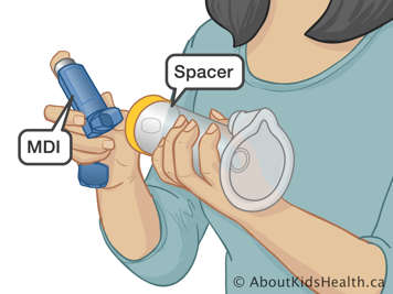 Attaching a metered-dose inhaler to the adapter of a spacer
