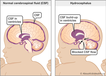 Baby with normal cerebrospinal fluid (CSF) outside of brain and baby with accumulation of CSF in the ventricles
