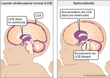 Bébé avec liquide cérébrospinal normal (LCS) autour du cerveau et bébé avec accumulation de LCS dans les ventricules