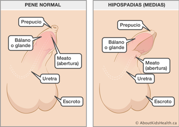Identificación del meato (abertura), prepucio, glande, uretra y escroto en un pene normal y en un pene con el hipospadias