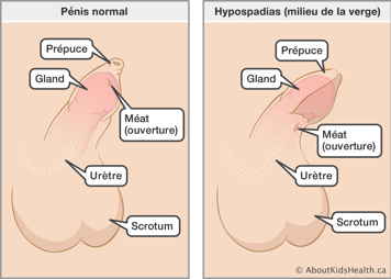L’emplacement du prépuce, du gland, du méat, de l’urètre et du scrotum dans un pénis normal et dans un pénis avec hypospadias
