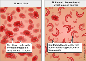 Red blood cells with normal hemoglobin carry enough oxygen—sickled red blood cells with abnormal hemoglobin carry less oxygen
