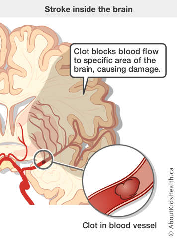 Clot in blood vessel in brain blocks blood flow to an area of brain, causing damage, indicated with shadow over part of brain