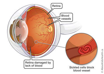 Sickled cells block blood vessels in the retina, near the middle of the eye, causing damage, which is indicated with a shadow