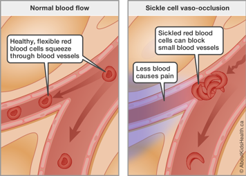 Sickled red blood cells can block small blood vessels, and less blood causes pain