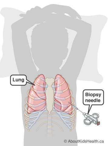Ling biopsy needle