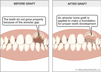 Bone graft creates a foundation for proper teeth development