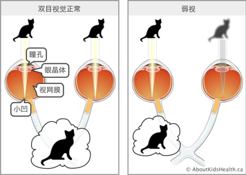 弱视示意图：从右眼看到的猫非常清晰，而左眼看到的猫是模糊的