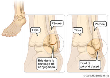 Le tibia, le péroné et un bris dans le cartilage de conjugaison sont indiqué sur une cheville