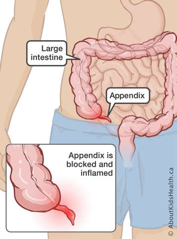 Location of the large intestine and appendix in the body with a depiction of a blocked and inflamed appendix