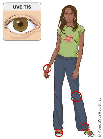 Identification of the wrist, knee, ankle and toe joints on a girl&rsquo;s body, and illustration of an eye affected by uveitis