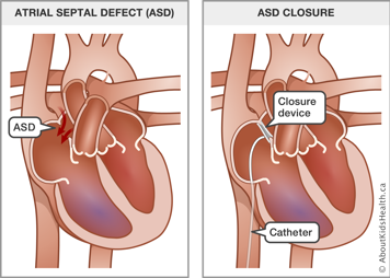 A heart with an atrial septal defect before procedure and a heart with a closure device and catheter