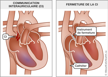 Un cœur avec une communication interauriculaire avant intervention et un cœur avec un instrument de fermeture et un cathéter