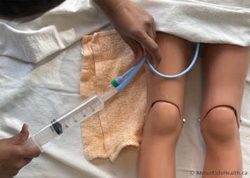 syringe at catheter tip