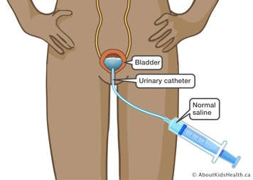Catheter inserted through the urethra filling the bladder with normal saline