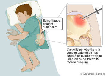 Une aiguille pénétrant dans l’épine iliaque postéro-supérieure jusqu’à ce qu’elle atteigne la moelle osseuse