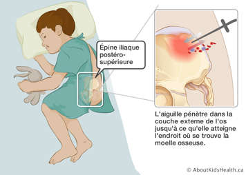 Aiguille pénétrant dans la couche externe de l’os pour atteindre la moelle osseuse dans l’épine iliaque postéro-supérieure