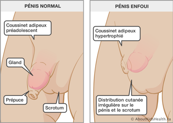 Pénis normal et pénis enfoui avec coussinet adipeux hypertrophié et distribution cutanée irrégulière sur le pénis et scrotum